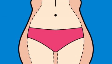 Cosmetic Surgery - fat & thin after tummy tuck
