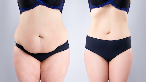 tummy tuck surgery cost complications what to expect